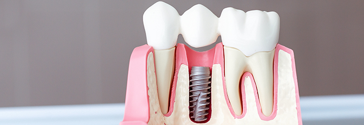 Who is a Candidate for Dental Implants?