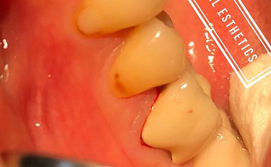 Case 7 before smile design pasadena