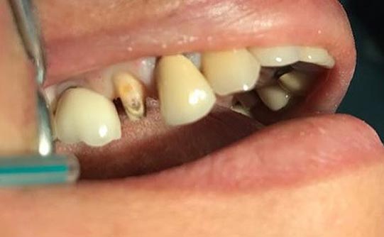 Case 11 before smile design pasadena