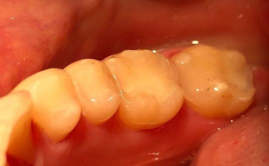 Case 2 after smile design pasadena