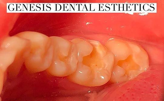 Case 5 before smile design pasadena