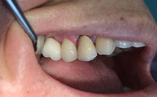 Case 11 after smile design pasadena