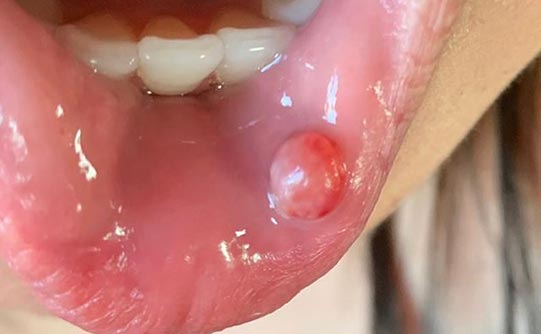 Case 1 before smile design pasadena