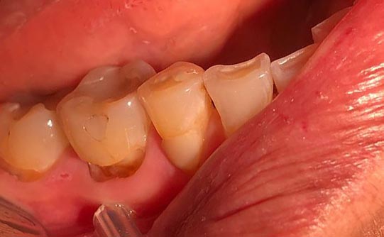 Case 8 before smile design pasadena