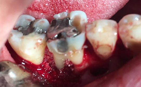 Case 10 after smile design pasadena