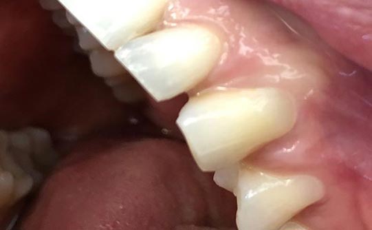 Case 9 after smile design pasadena