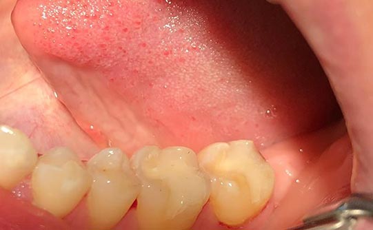 Case 3 after smile design pasadena