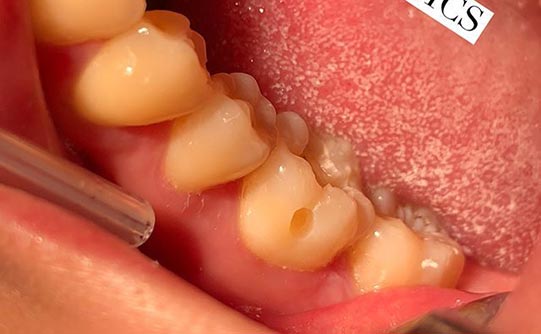 Case 4 before smile design pasadena