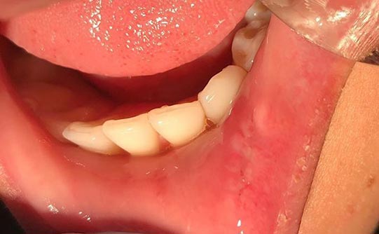 Case 1 after smile design pasadena