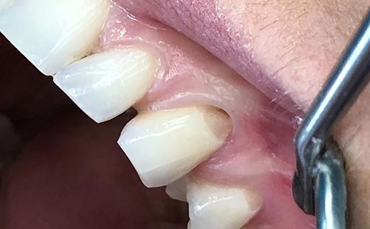 Case 9 before smile design pasadena