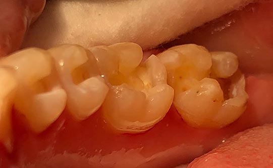 Case 2 before smile design pasadena