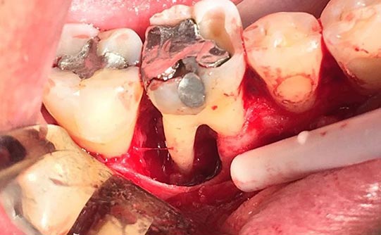 Case 10 before smile design pasadena