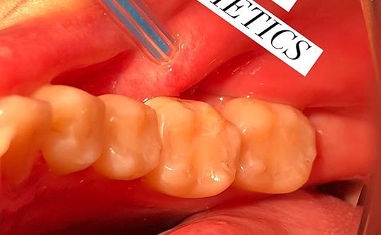 Case 5 after smile design pasadena