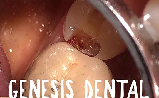 Case 6 before smile design pasadena