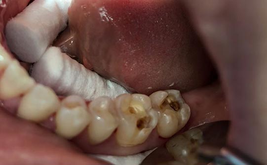 Case 3 before smile design pasadena