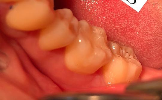 Case 4 after smile design pasadena